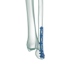 Distal Fibula Posterolateral Anatomik Plak2