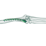 Distal Humerus Posterolateral Anatomik Plak2